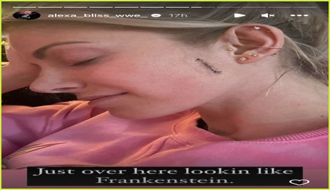 WWE's Alexa Bliss posts photo of stitches from skin cancer surgery